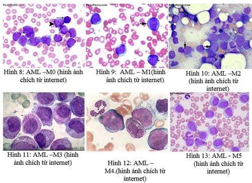 Bạch cầu cấp tính dòng tế bào tủy xương (AML): Chẩn đoán, điều trị