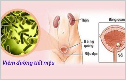 Khi có sự hiện diện của vi khuẩn trong nước tiểu là bằng chứng của viêm đường tiết niệu.