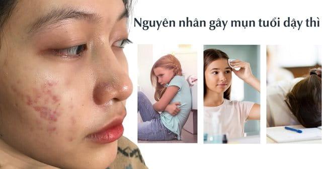 Nguyên nhân gây mụn tuổi dậy thì