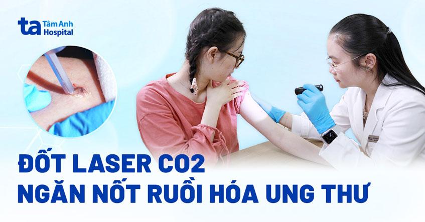 Đốt laser ngăn nốt ruồi hóa ung thư