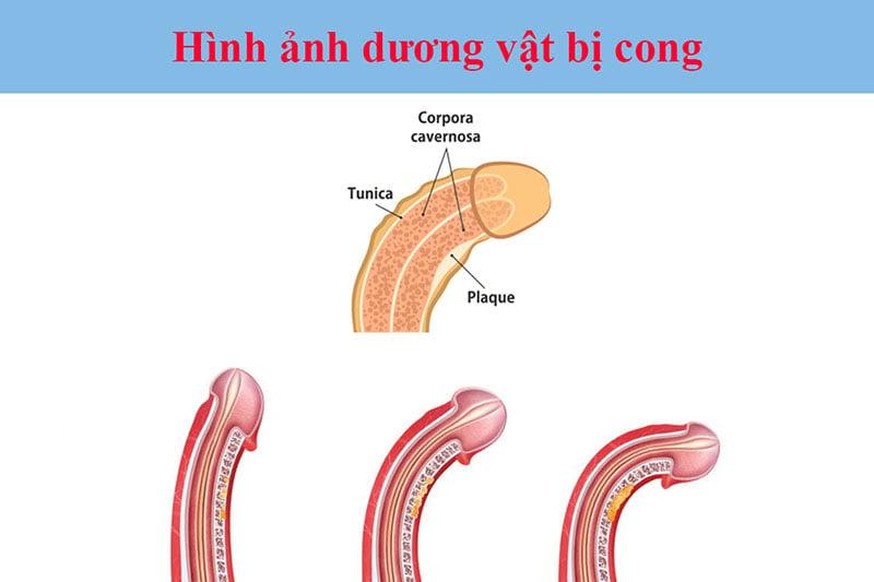 Dương vật bị lệch sang trái