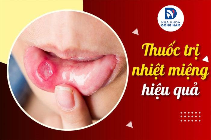 Thuốc Trị Lở Miệng Hiệu Quả