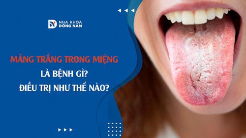 Mảng trắng trong miệng là bệnh gì? Điều trị như thế nào?